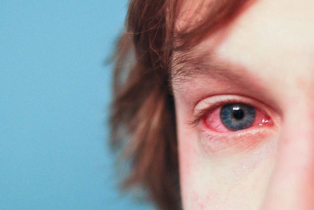 Alergias Ojos Moho Panama alergias ojos moho hongo panama